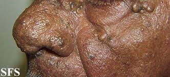 Usually develops in the skin of older adults. File Favre Racouchot Syndrome 04 Png Wikidoc