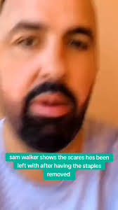 Staples Removal Clavical