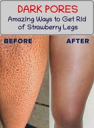 How To Finally Get Rid Of Strawberry Legs Strawberry Legs Ingrown Leg Hair Dark Pores