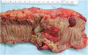 Gadis kecil molek, comel mcm ni rupanya menghidap kanser.tahap 4. Bila Kerap Cirit Awas Itu Risiko Ada Kanser Usus Remaja