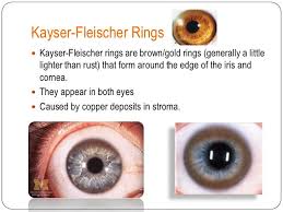 Image result for Copper Poisoning