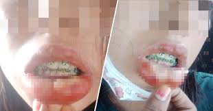 Harga braces di klinik kerajaan tawaran untuk pelajar sekolah. Gigi Palsu Di Klinik Kerajaan