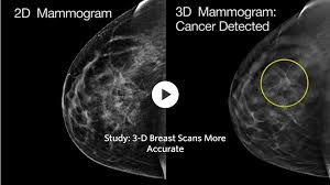 Cancers may be seen as masses (like a ball, but usually with an irregular shape), areas of asymmetry that resemble normal tissue, calcifications (white specks), and/or areas of architectural distortion (imagine the puckering caused by pulling a thread in a piece of fabric). 3d Scans More Accurate Than Regular Mammograms