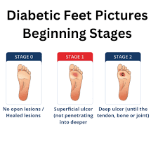 Image result for diabetic toes