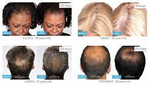 Laser therapy is similar to watering plants. Theradome Laser Hair Growth Helmet Advanced Hair Studio