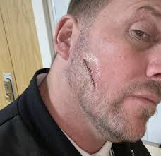 Dad's 'Ingrown Hair or Pimple' Turned Out To Be Skin Cancer