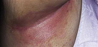 Image result for Intertrigo under breasts