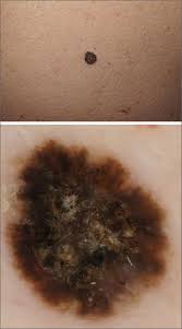 Image result for Papule