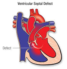 ventricular septal defect vsd american heart association