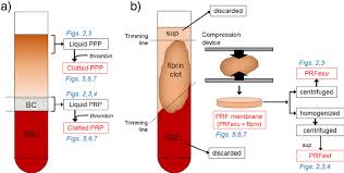 Platelet rich fibrin to bogatopłytkowa fibryna (prf) , którą uzyskuje się z krwi pacjenta. A Preparation Of Ppp And Prp Samples B Preparations Of Prf Samples Download Scientific Diagram