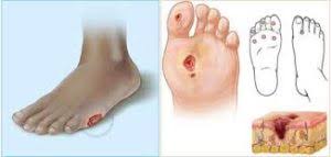 Pacjentów z cukrzycą (z badań ankietowych przeprowadzonych w. Stopa Cukrzycowa Podologia Warszawa Wrastajace Paznokcie