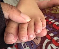 Image result for Clubbing nails feet