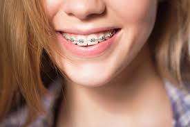 Crowding just means that there is not enough space in the mouth for all of the teeth that need to be there. Is Invisalign An Option If You Ve Had Traditional Braces Watkin Dental Associates