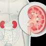 Qué significa lito en medicina de www.clinicbarcelona.org
