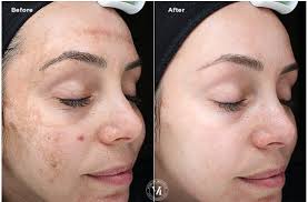 Image result for Melasma