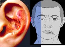 SNHL #hearingloss collection of important questions: 1. A 52-year-old woman  presents with a gradual hearing loss showing a moderate slope towards the  high frequencies but disproportionately severe decrease in speech  discrimination. What