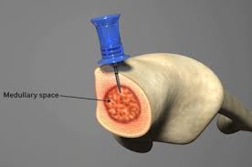 Image result for Intraosseous Access