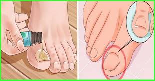 How does an ingrown toenail happen? 10 Home Remedies To Get Rid Of Ingrown Toenail Pain