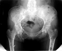 Multiple myeloma is a cancer of plasma cells, which are white blood cells found mainly in the bone marrow. Why Does This Woman Have Punched Out Bone Lesions