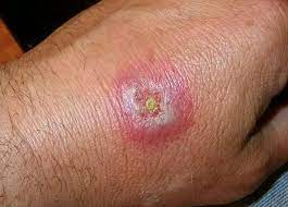 See spider bite pictures and learn how to identify bug bites from mosquitoes, bees, bed bugs, wasps, and more. Spider Bites Identification And Treatment