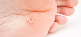 How to boost immune system to fight and eliminate hpv virus faster? How To Get Rid Of Warts Naturally Wart Symptoms Causes Dr Axe