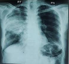 Image result for Air Bronchogram