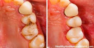 How to reverse receding gums naturally at home. How To Heal Cavities And Tooth Decay Naturally Heal Cavities Teeth Health Tooth Decay