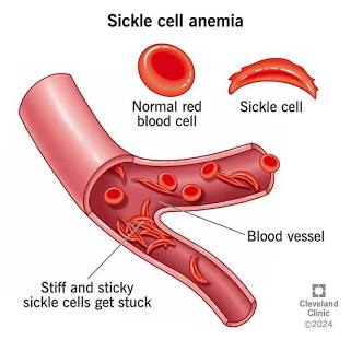 How sickle cell disease blocks normal blood flow, AI generated