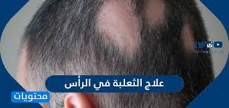 ما هو علاج الثعلبة في الراس موقع محتويات