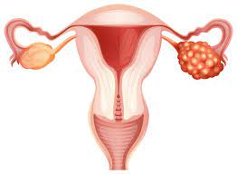 Common types of ovarian cancer. Is There A Cure For Ovarian Cancer Pintas Mullins Law Firm
