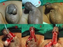 Résultat de recherche d'images pour "penis degloved"