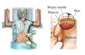 Image result for Bone Marrow Exam