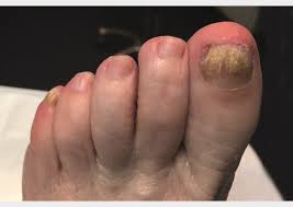 Yet a fungal infection can ruin the appearance of your nails and cause pain as it lifts the. Management And Treatment Options For Common Foot Conditions Learning Article Pharmaceutical Journal