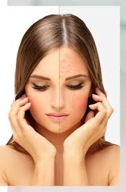 Effective Rosacea Relief: IPL and Venus Viva™ Treatments Plus Skincare  Strategies