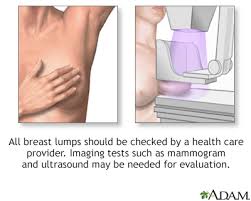 But if you find a lump in your breast, see a doctor as soon as possible. Breast Lump Information Mount Sinai New York