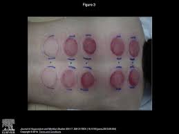 Numerical Analysis Of The Change In Skin Color Due To