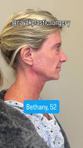 Bethany, 52, is 5 days after her Omakase Facelift®️ She has a disarming,  gentle sweetness about her. Her surgery included: ✅ Deep plane extended  facelift ✅ Deep necklift (#neckbynayak) ✅ Minimal ...