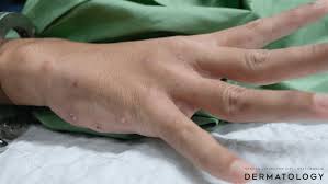 Image result for scabies bite