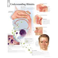 Image result for Allergic Rhinitis