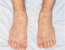 Thus, identifying the underlying cause is an important component of patient management. Palpable Purpura Of The Distal Extremities Is The Most Common Download Scientific Diagram