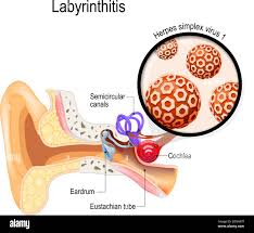 Image result for Vestibular Neuronitis