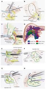 Bile is stored in the gallbladder, a pouch on the right side of the abdomen under the liver. Protocol For Laparoscopic Cholecystectomy Is It Rocket Science