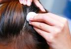 Oily Dandruff
