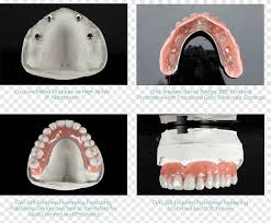 Drg militer tni al jembatan komposit esthetic dentist. Tooth Implan Gigi Jembatan Gigi Palsu Jembatan Fotografi Laboratorium Png Pngegg