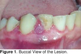 Image result for granuloma gum disease