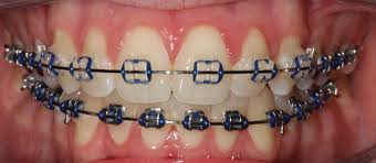 Women often choose colors for braces that match their favorite shade of lipstick or their natural lip color. Braces Colours Show Off Your Personality With Colour
