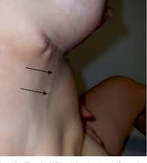 What are the other names for this condition? Figure 2 From Mondor S Disease Report On Three Cases And Literature Review Semantic Scholar