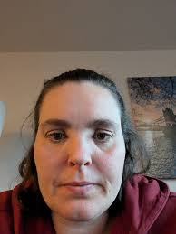 Eye issues possibly related to EDS?