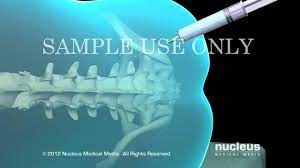 Anestesia Peridural Y Raquidea Youtube