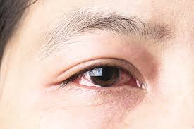 Symptoms of eye cancer can include: How To Prevent Common Eye Problems The Pharmaceutical Journal
